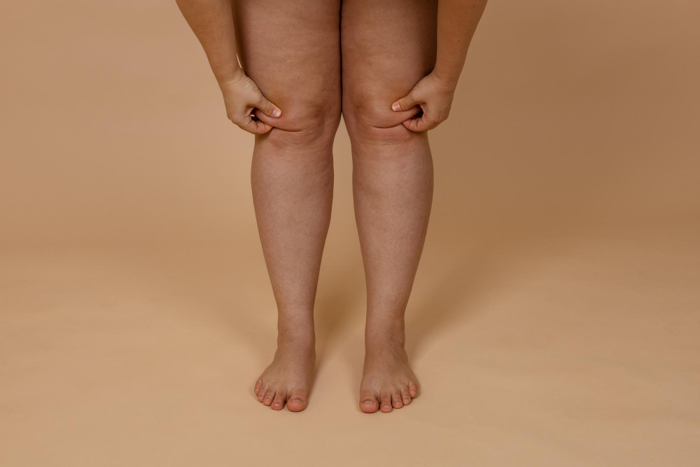 Lipedema: marcadores genéticos e abordagens nutricionais